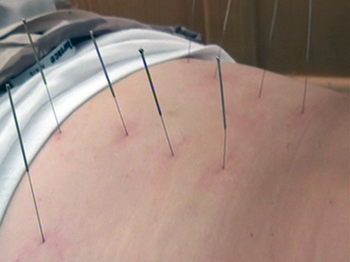 Acupunctura (c) eMM.ro